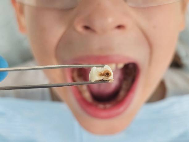 Best Emergency Dental Care for Abscessed Tooth in Intercourse, PA